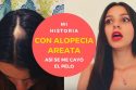 Alopecia Areata, consejos y solución.