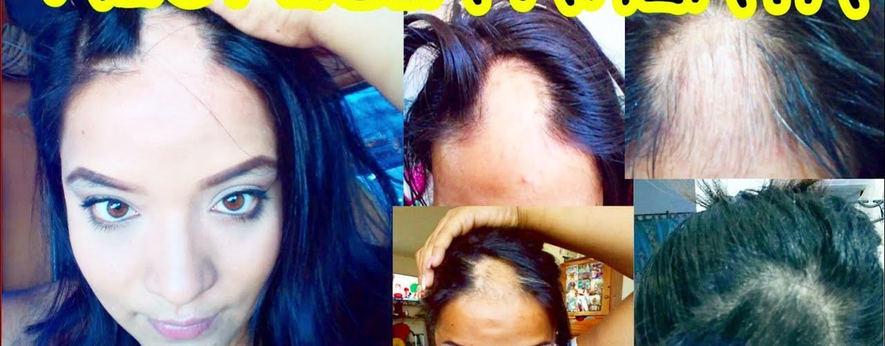 Tengo alopecia Areata – como curar la alopecia – caida de cabello – calvicie – enfermedades