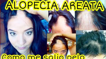 Tengo alopecia Areata – como curar la alopecia – caida de cabello – calvicie – enfermedades